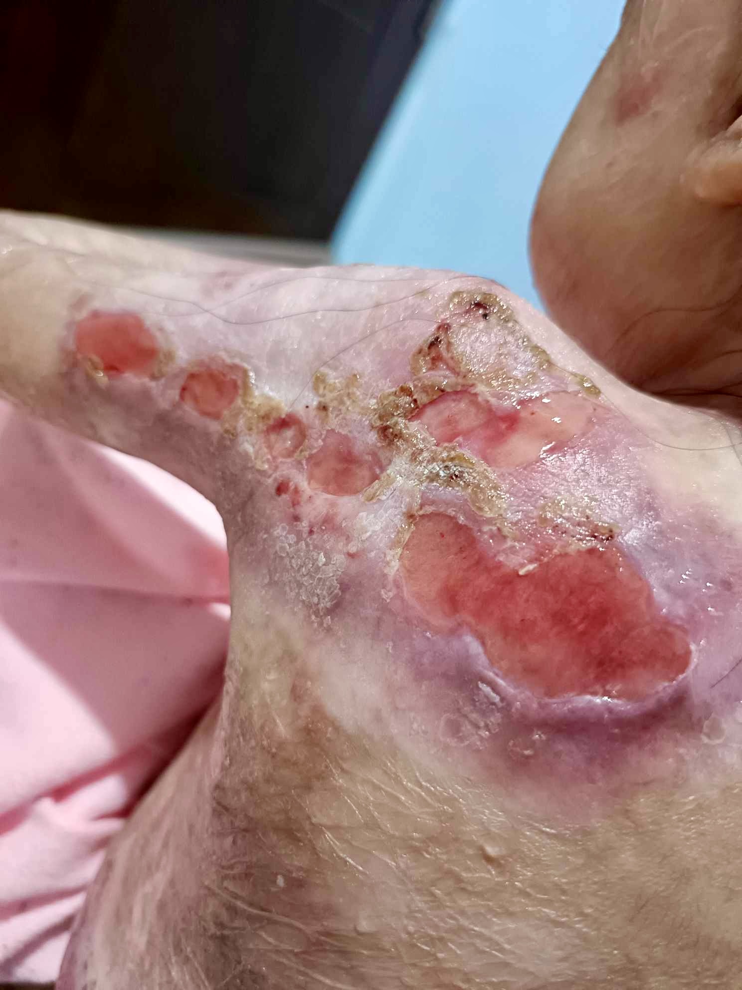 Please Donate to Stop Shamila's Severe Pain and Help Save Her Life — photo 4